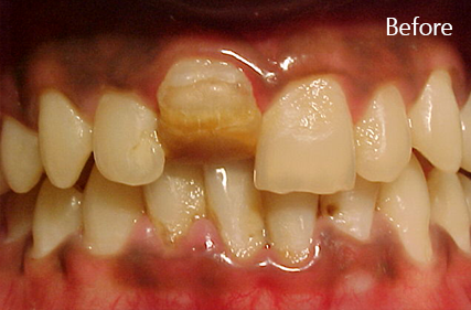 Curved tooth (Dilaceration)